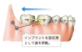 インプラントを固定源として歯を移動